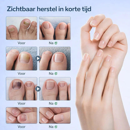 NailRestore – Réparez visiblement vos ongles de l'intérieur